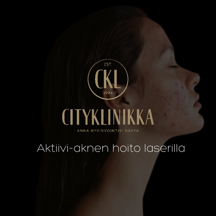 Laser treatment of active acne - HELSINKI